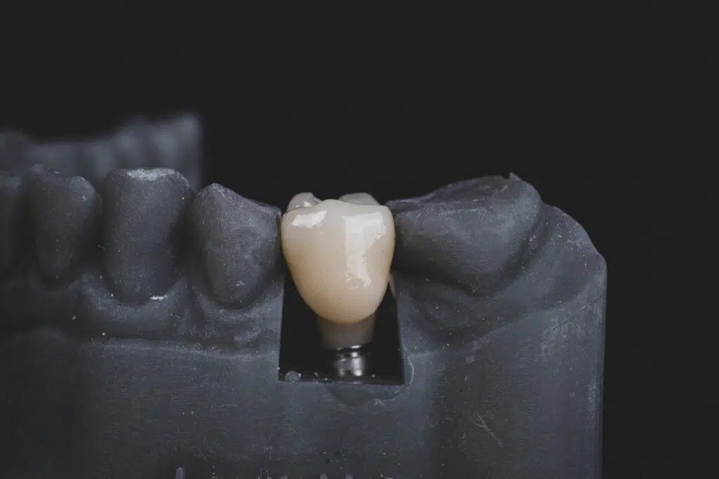 Chipped Or Broke Your Tooth? Here’s What You Should Do